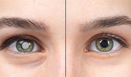 Auge mit Kararakt (links) und gesundes Auge (rechts)